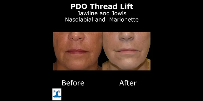 PDO Threadlift before and after