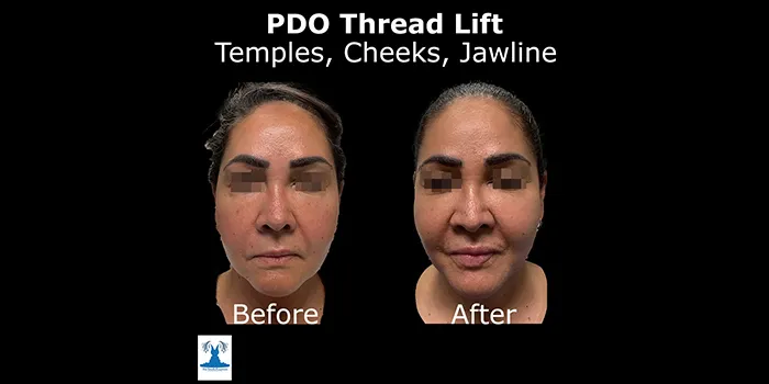 PDO Threadlift before and after