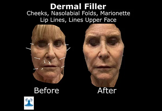 Dermal filler before and after