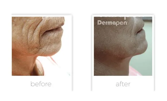 Dermapen before and after