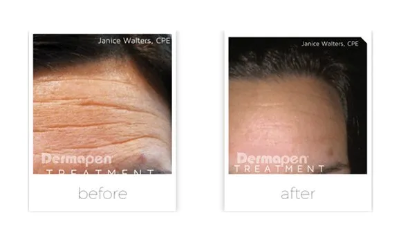 Dermapen before and after