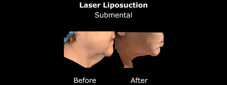 Laser lipo before and after