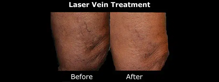 Laser treatment before and after