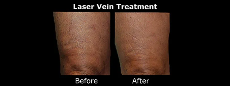 Laser treatment before and after