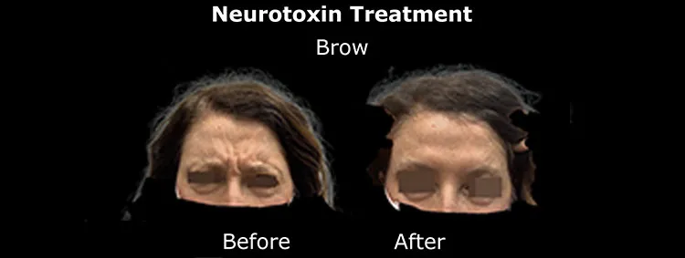 Neurotoxin before and after