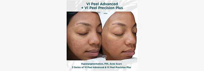 Chemical peel before and after