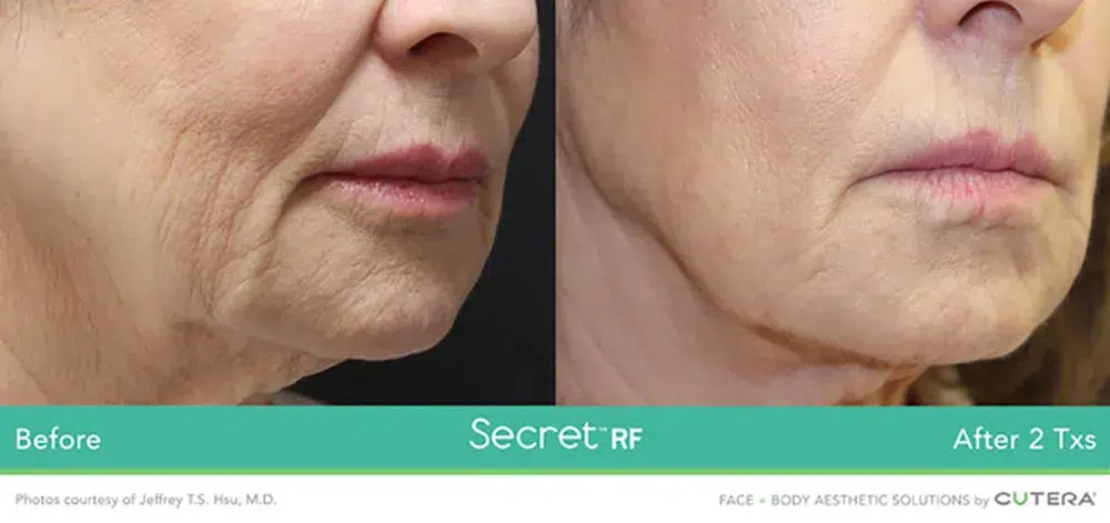 RF Microneedling before and after