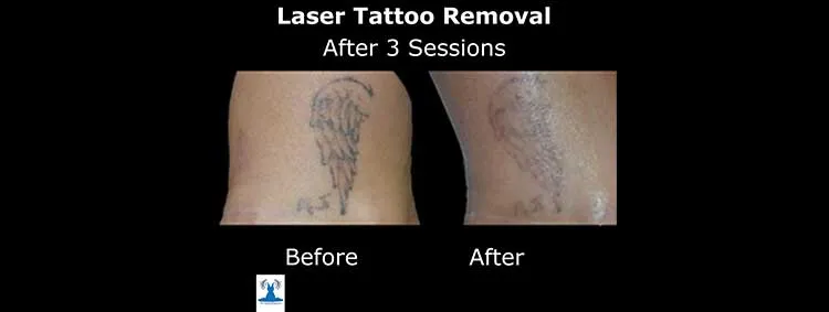 Tattoo removal before and after