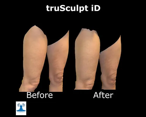 truSculpt ID before and after