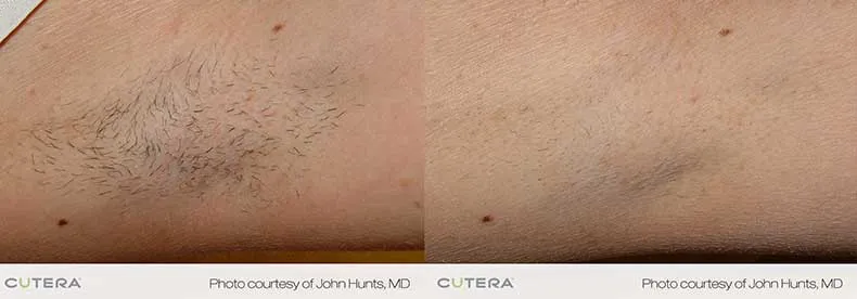 Laser hair removal - under arm