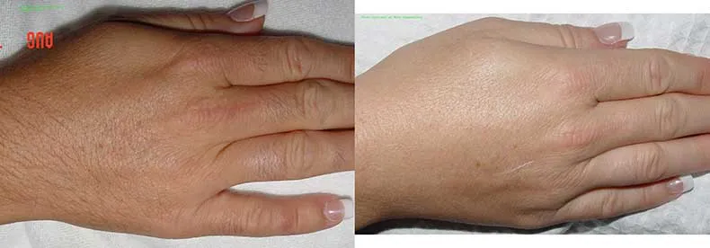Laser hair removal - hand