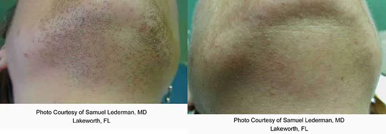 Laser hair removal - chin