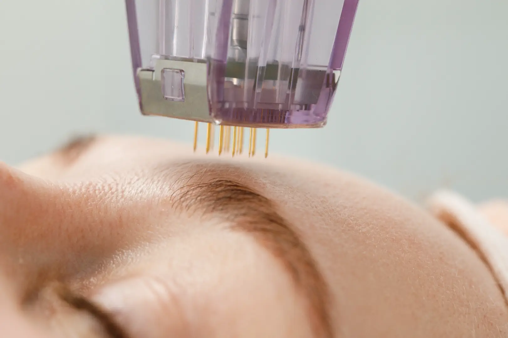 Close-up of a handheld treatment device with small needles positioned above a woman's forehead