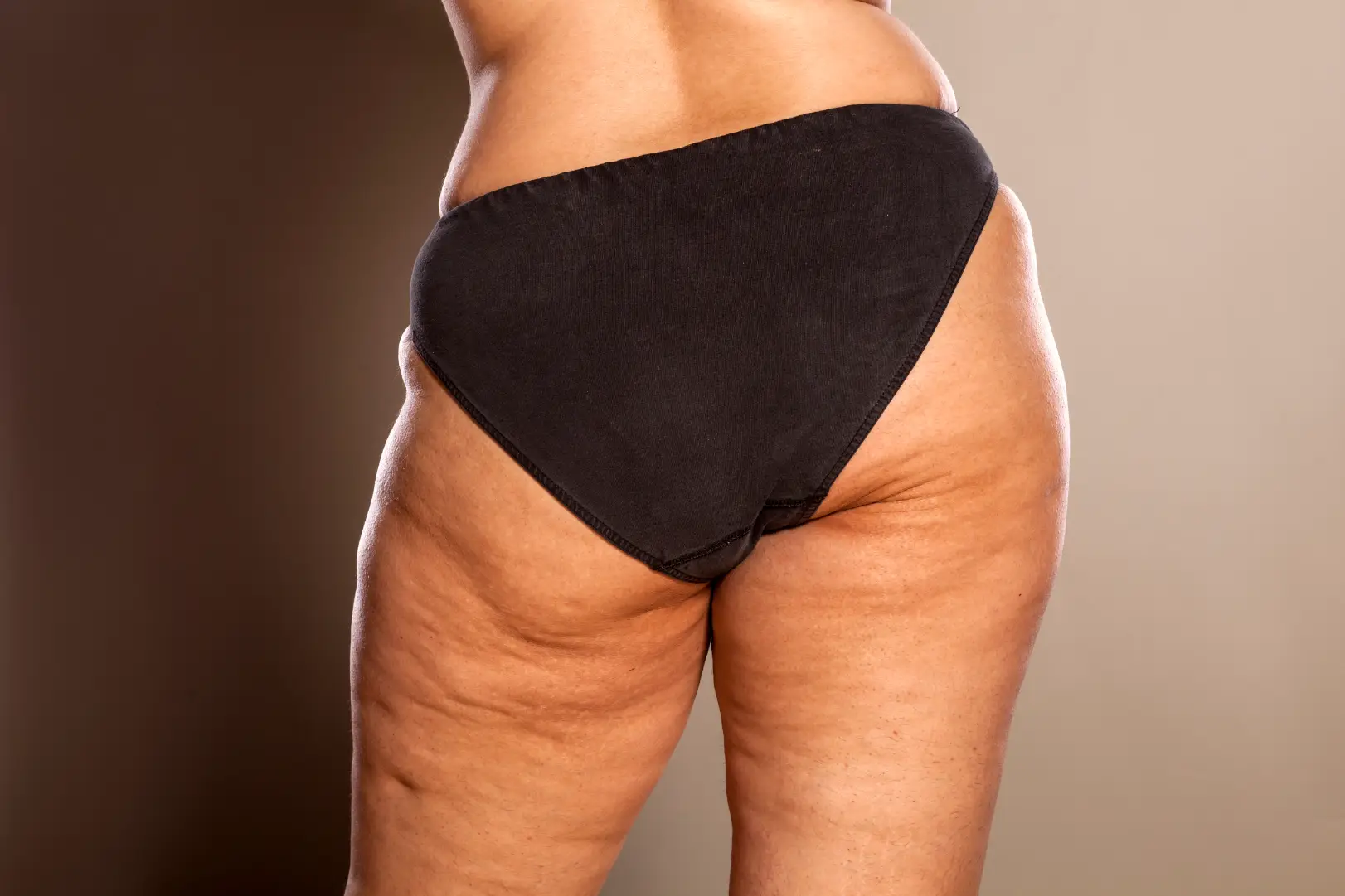 Rear view of a person wearing black underwear with visible dimples and uneven skin texture on the buttocks and upper thighs.